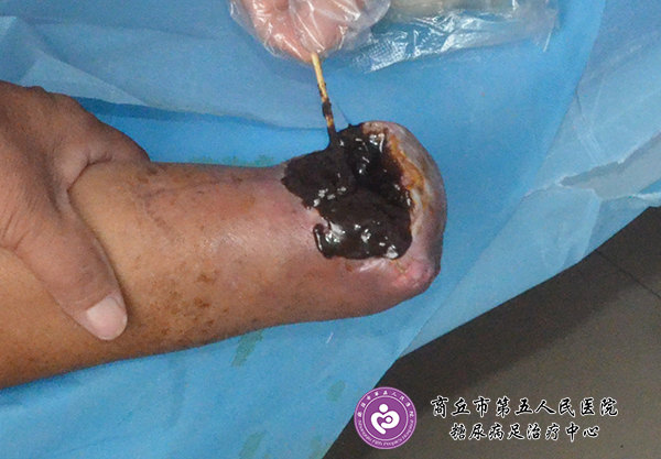 康复案例:糖尿病人上肢外伤截肢感染不愈合一例