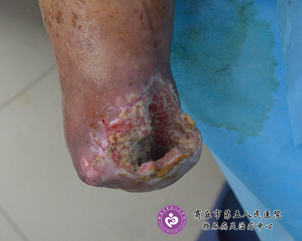 康复案例:糖尿病人上肢外伤截肢感染不愈合一例