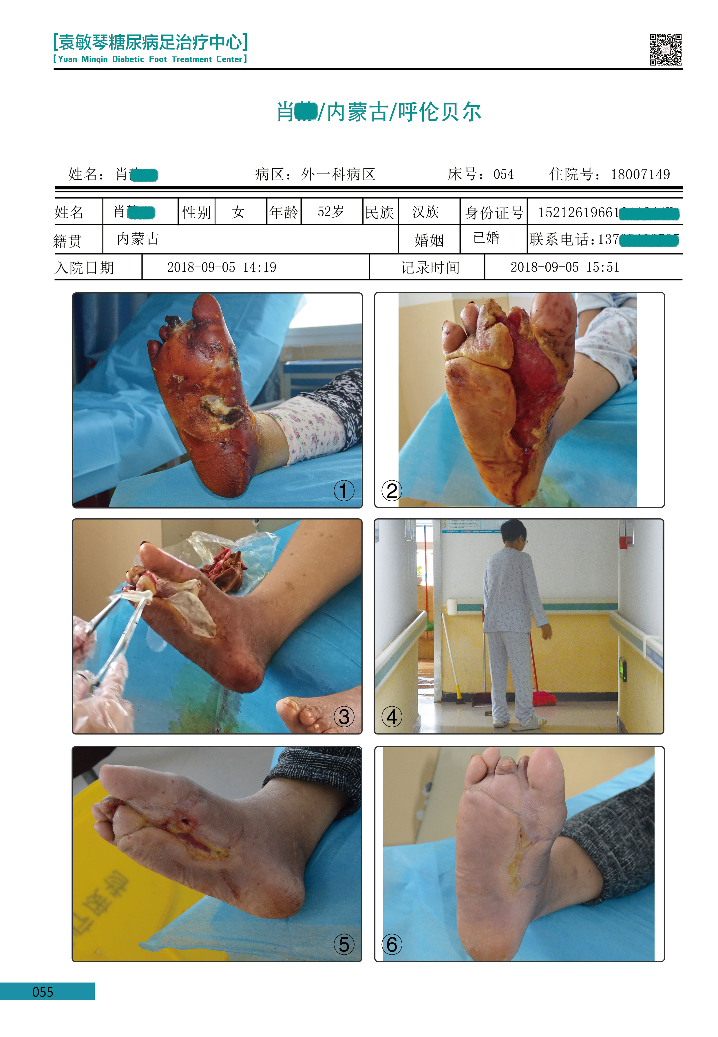 治疗糖尿病足目前都存在哪些问题